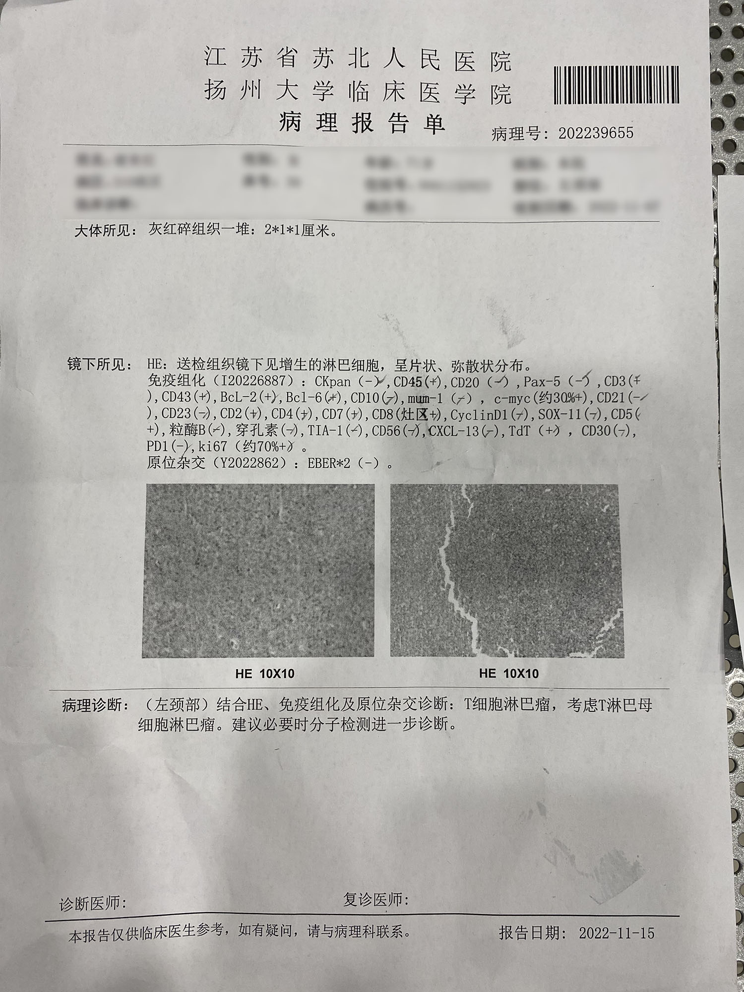 苏北医院病理报告