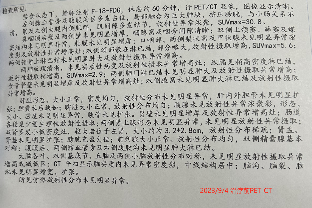 治疗前PET-CT