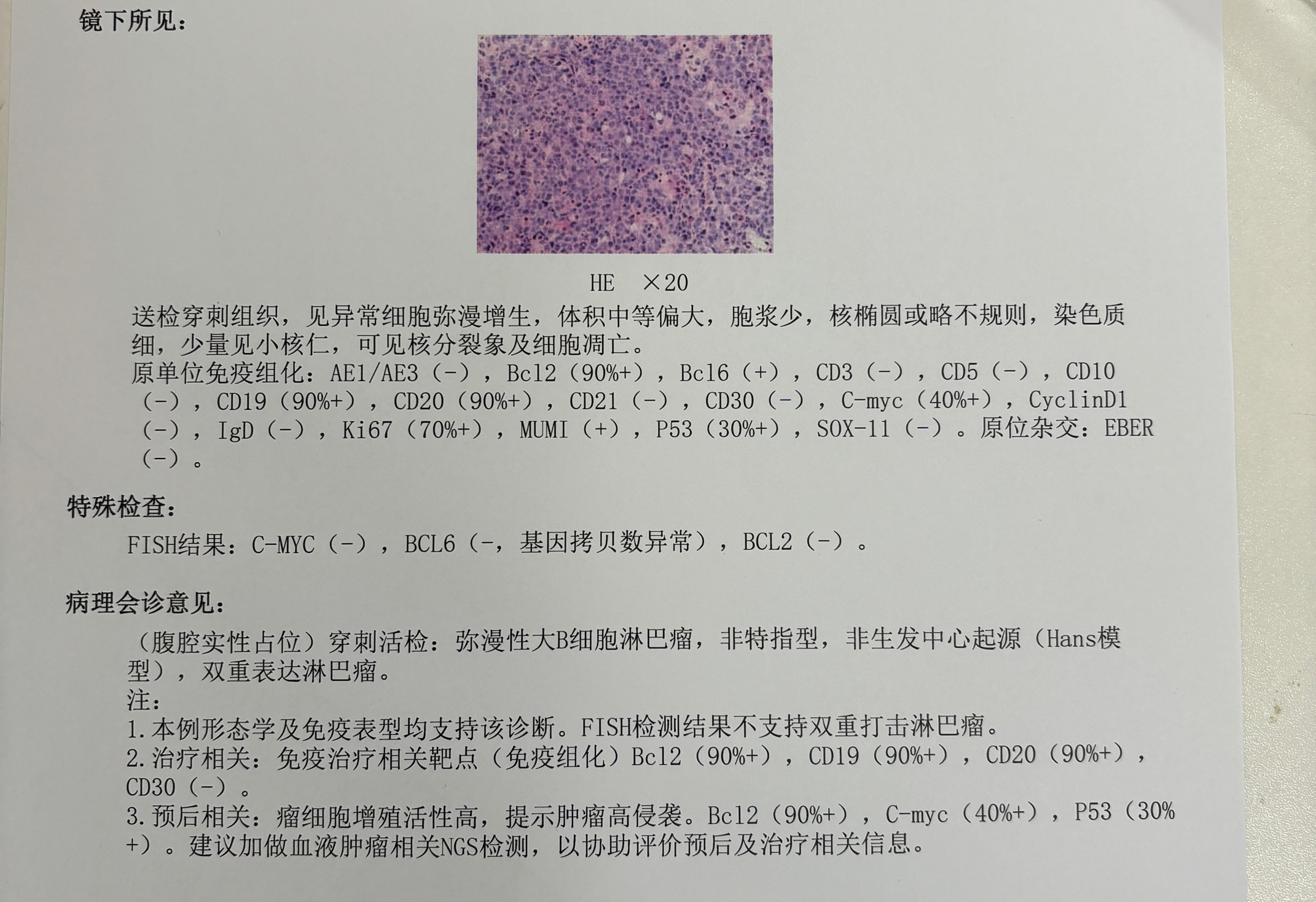 24年腹部新发大包块穿刺病理诊断为弥漫大B