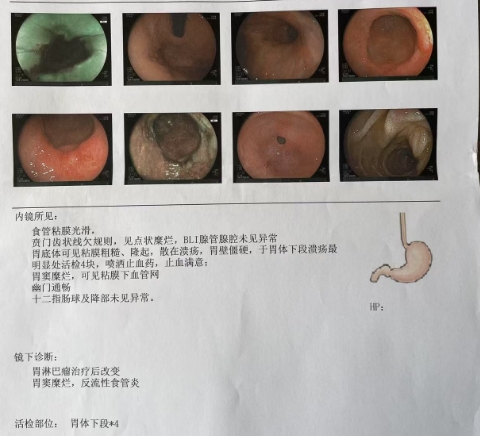 病理提示是炎症